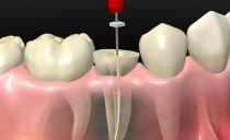 What is tooth depulpation, methods of depulpation with prosthetics