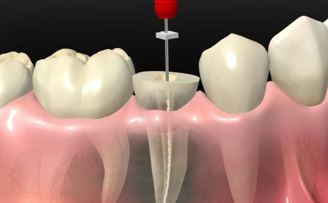 Hvad er tand depulpation, metoder til depulpulation med proteser