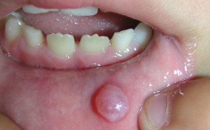 Bulles à l'intérieur de la lèvre: causes, symptômes, traitement, photo