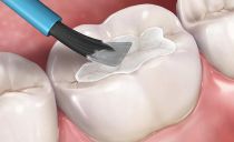 איטום סדקים של שיניים אצל ילדים ומבוגרים: מהם אלה, היתרונות והחסרונות