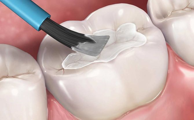 Brtvljenje pukotina na zubima kod djece i odraslih: što su ovi, za i protiv