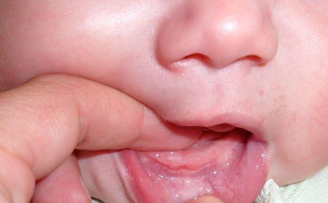 Kokie yra balti taškeliai, spuogai ir dėmės ant kūdikio dantenų?