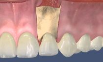 Ressecção do ápice da raiz do dente: a essência e as etapas da operação, recuperação após a cirurgia