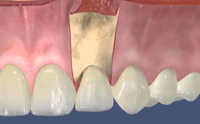 Rezecția apexului rădăcinii dintelui: esența și etapele operației, recuperarea după operație