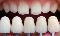 Kiek kainuoja odontologijoje gaminti ir klijuoti lakštus ant priekinių dantų