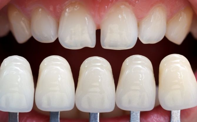 How much does it cost to make and put veneers on the front teeth in dentistry