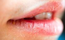 Cheilite sulle labbra: cause, sintomi, metodi di trattamento