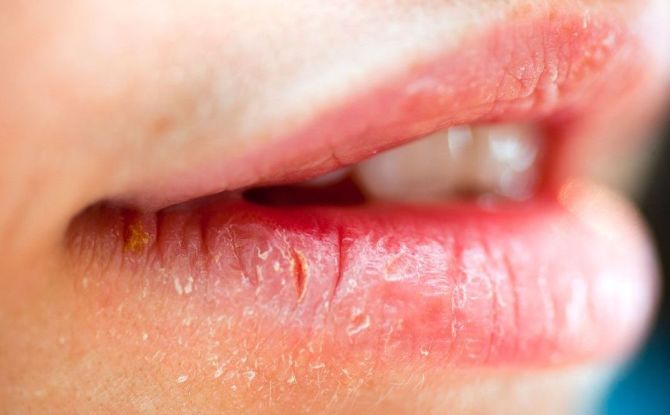 Queilitis en los labios: causas, síntomas, métodos de tratamiento.