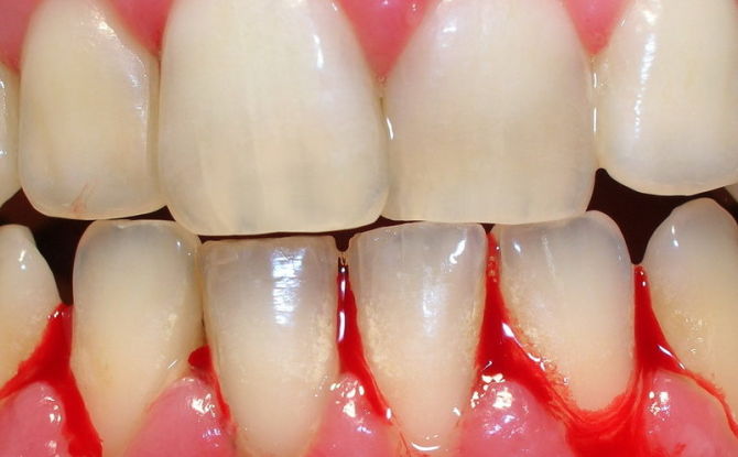 Blødende tandkød: årsager, behandling, hvad der skal gøres derhjemme