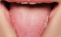Schwellung der Zunge: Ursachen und Behandlung