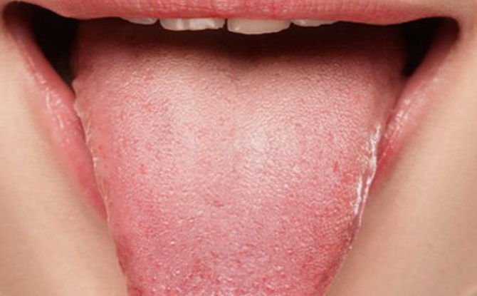 Подуване на езика: причини и лечение