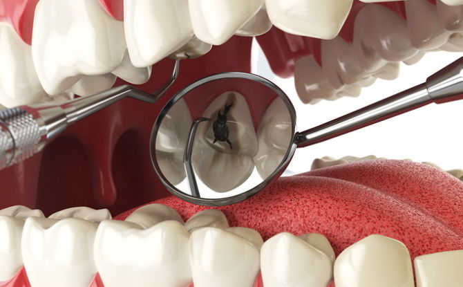 Tekenen, symptomen en behandeling van pulpitis van de tand