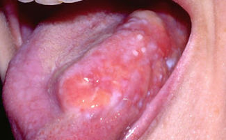 Cancer on the side of the tongue