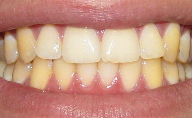 Gula tänder hos vuxna och barn: orsaker, blekningsmetoder, foto