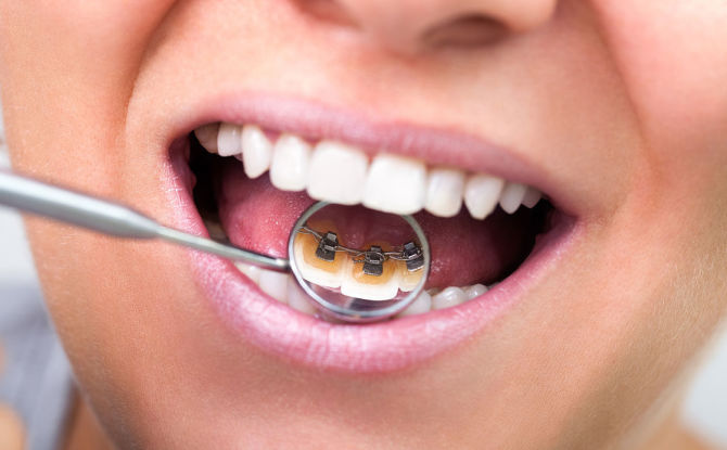 Comment mettre un appareil dentaire sur les dents: types, conditions de port et d'installation