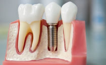 Implants dentaires: types, coût et installation