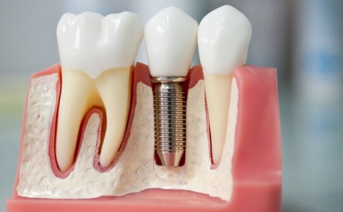 Implan gigi: jenis, kos dan pemasangan