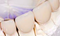 Crowns on the front teeth: types of how they make and establish how much they cost