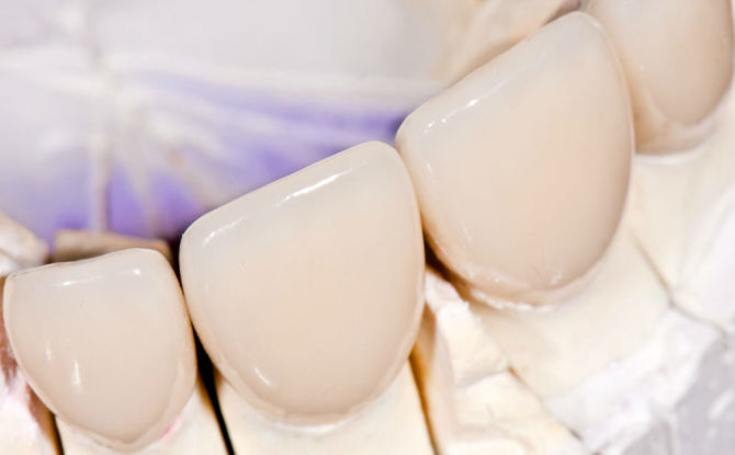 כתרים בשיניים הקדמיות: סוגים של איך הם מייצרים וקובעים כמה הם עולים