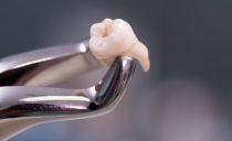Recomendações após a remoção do dente do siso: quando você pode comer e beber, especialmente cuidados