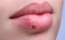 Erupciones herpéticas en los labios: la naturaleza de la enfermedad, síntomas, tratamiento.