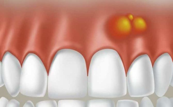Pus i tandkødet: hvad der skal gøres derhjemme, kirurgisk og medicinsk behandling