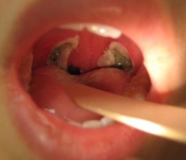Abscess in the throat