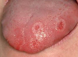 Glossitis aphthous