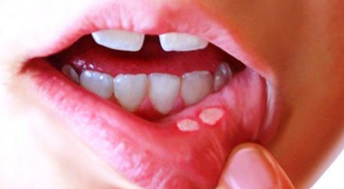 Aphthous stomatitis on the lip