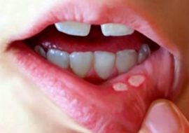 Aphthous stomatitis in the mouth