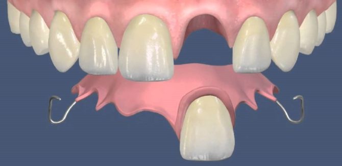 Prótesis acrílica de un diente