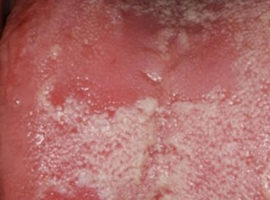 Allergiás glossitis