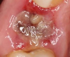 Alveolitis of the hole after removal of the wisdom tooth