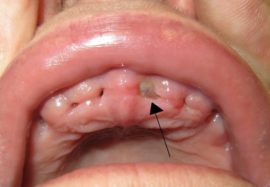 Alveolitis i tannstikkontakten