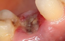 Alveolitis después de la extracción dental.