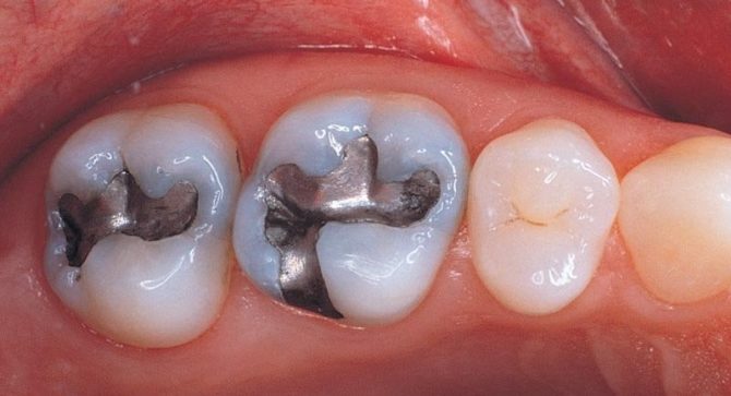 Amalgamfüllungen an den Zähnen