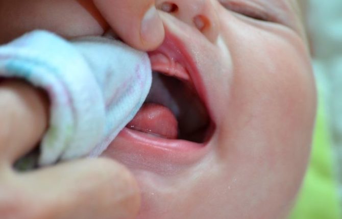 Tratamiento antiséptico de la cavidad bucal del bebé.