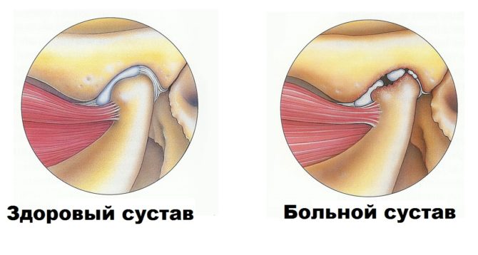 Artritis de la articulación temporomandibular.