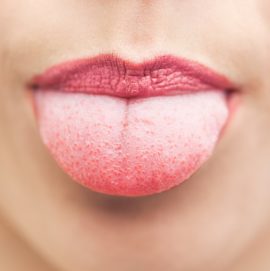 Dermatitis atópica en la lengua