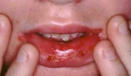 التهاب الفم البكتيري