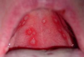 التهاب الفم البكتيري