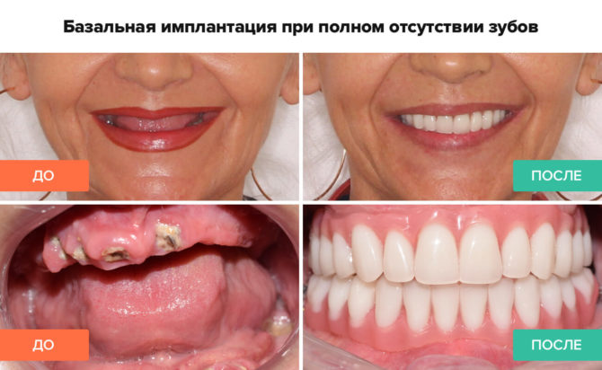 Implantul bazal cu absența completă a dinților