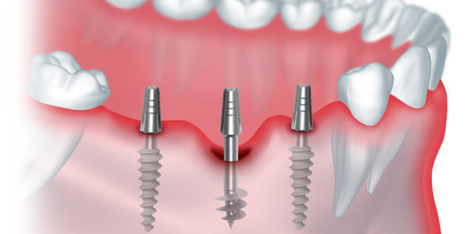 Bazinis dantų implantas