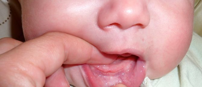 Vit prick på babyens tandkött