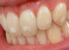 Những đốm trắng trên men răng