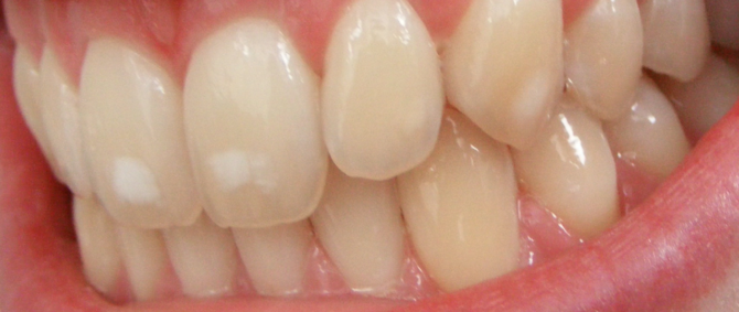 White spots on teeth