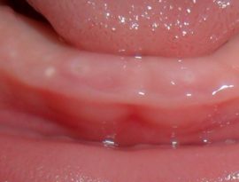Vita punkter på tandköttet med avitominos
