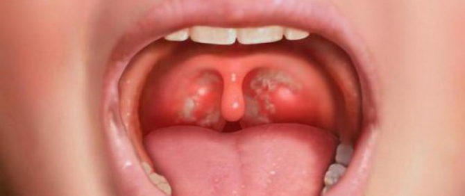 Mga puting tuldok sa tonsil