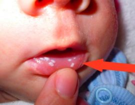 White spots in the mouth of the baby with candidiasis
