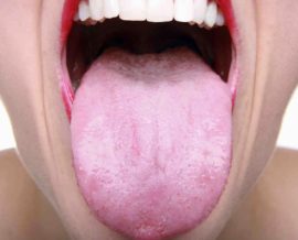 Revêtement blanc sur la langue